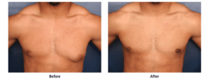 Before and after photos of a gynecomastia patient who has received male breast reduction surgery from Dr. Schuster in Baltimore.